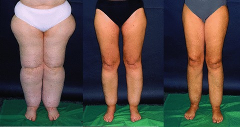 Can you lose weight with Lipedema? - Lipedema and Me