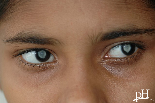 cataractsph.png